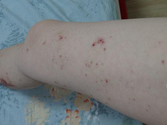 疹 中毒 足や腕、体のかゆみ（皮脂欠乏性湿疹・あせも・中毒疹・薬疹）