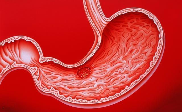 医生提醒:胃癌早期很隐蔽,四个信号要及时发现: 信号一,明显消瘦,常